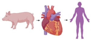 pig to human heart transplant