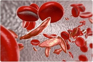 gene editing for sickle cell anemia